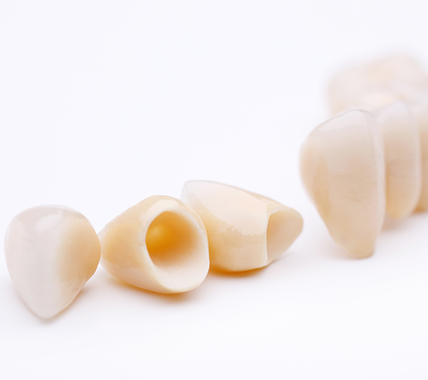 Brevard Dental Crowns and Dental Bridges