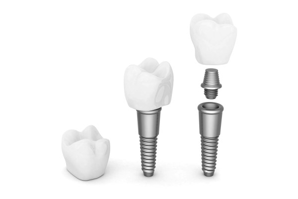 Can Dental Implants Replace Front Teeth?