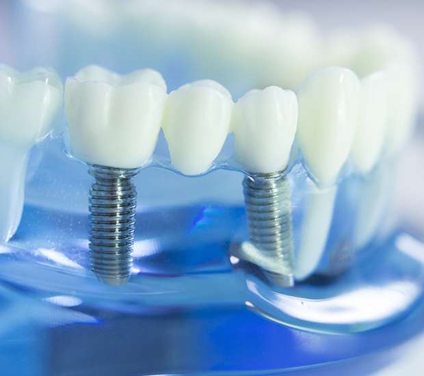 Brevard Dental Implants