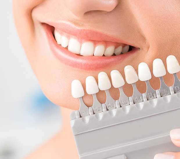 Brevard Dental Veneers and Dental Laminates
