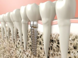 Are You A Candidate For Mini Dental Implants?
