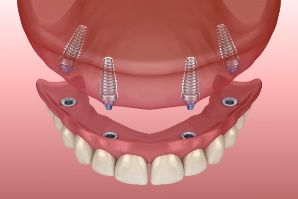 Recovery Tips After An Implant Supported Dentures Procedure