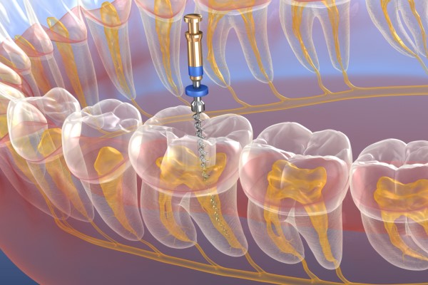 Root Canal Treatment Brevard, NC