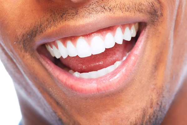 The First Step Of A Veneers Smile Makeover