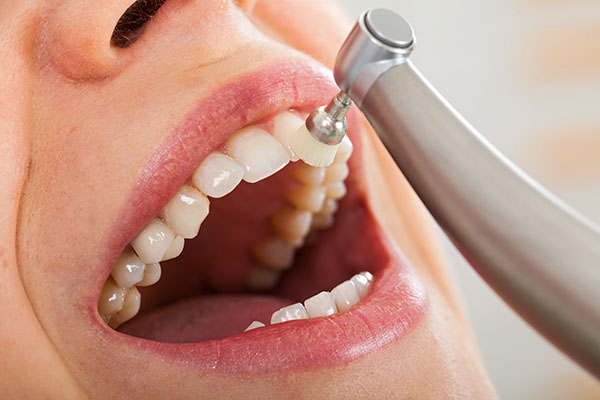 Why Is It Necessary to Get a Dental Cleaning? from Carolina Smiles Family Dental in Brevard, NC